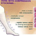 Varicose veins prevention with compression stockings