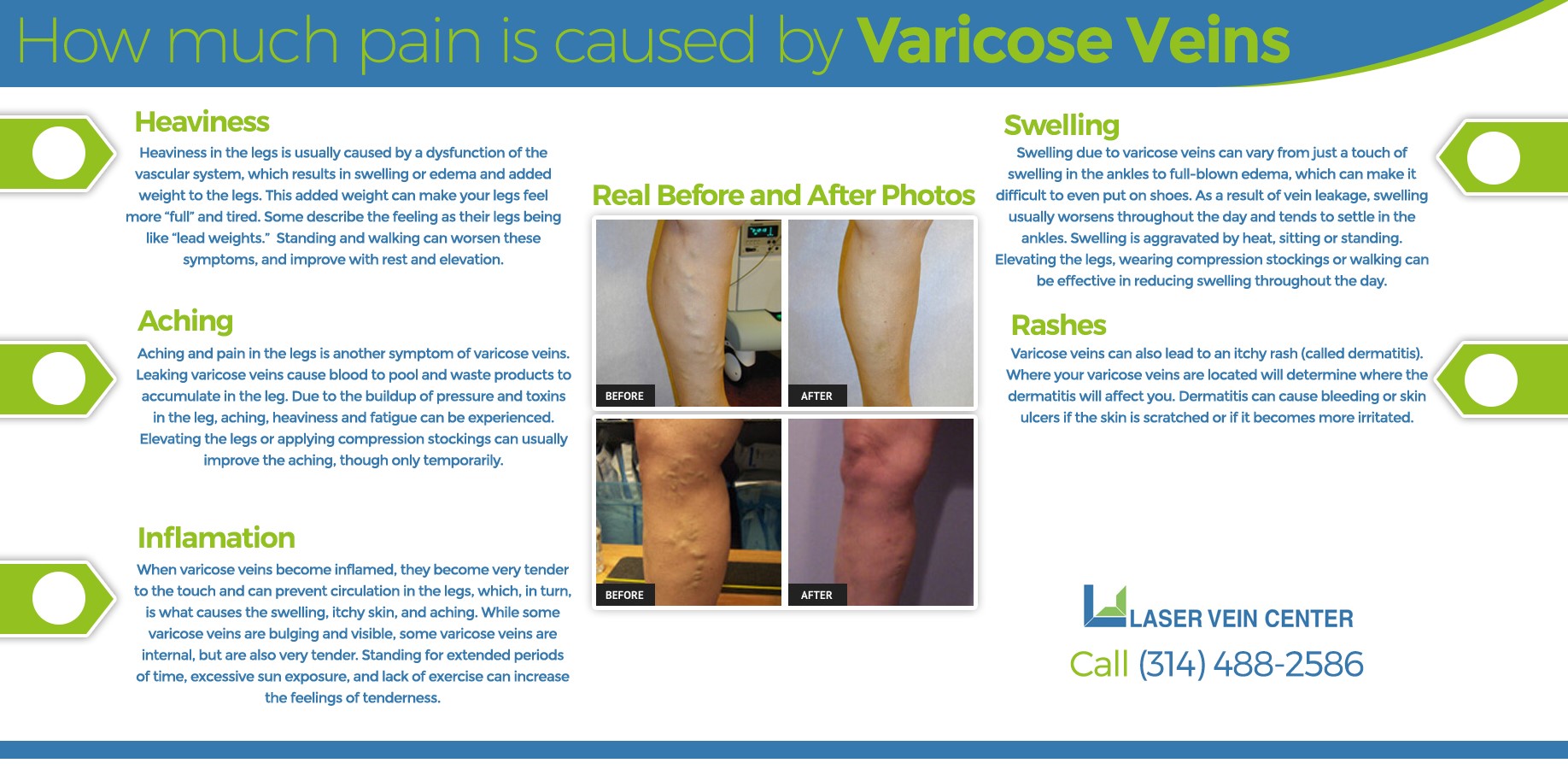 What Pain from Varicose Veins Feels Like | St Louis Laser Veins