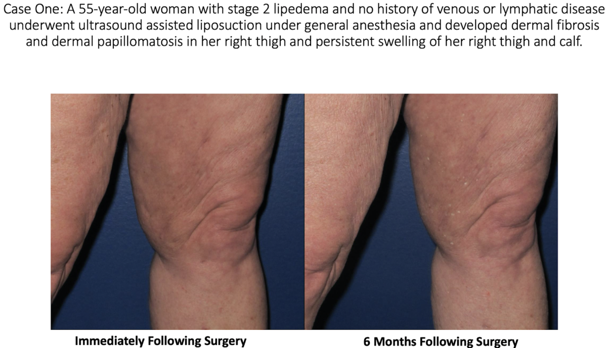 Lymphatic Injury After Liposuction For Lipedema St Louis Laser Veins lymphatic-injury-after-liposuction-for-lipedema-st-louis-laser-veins