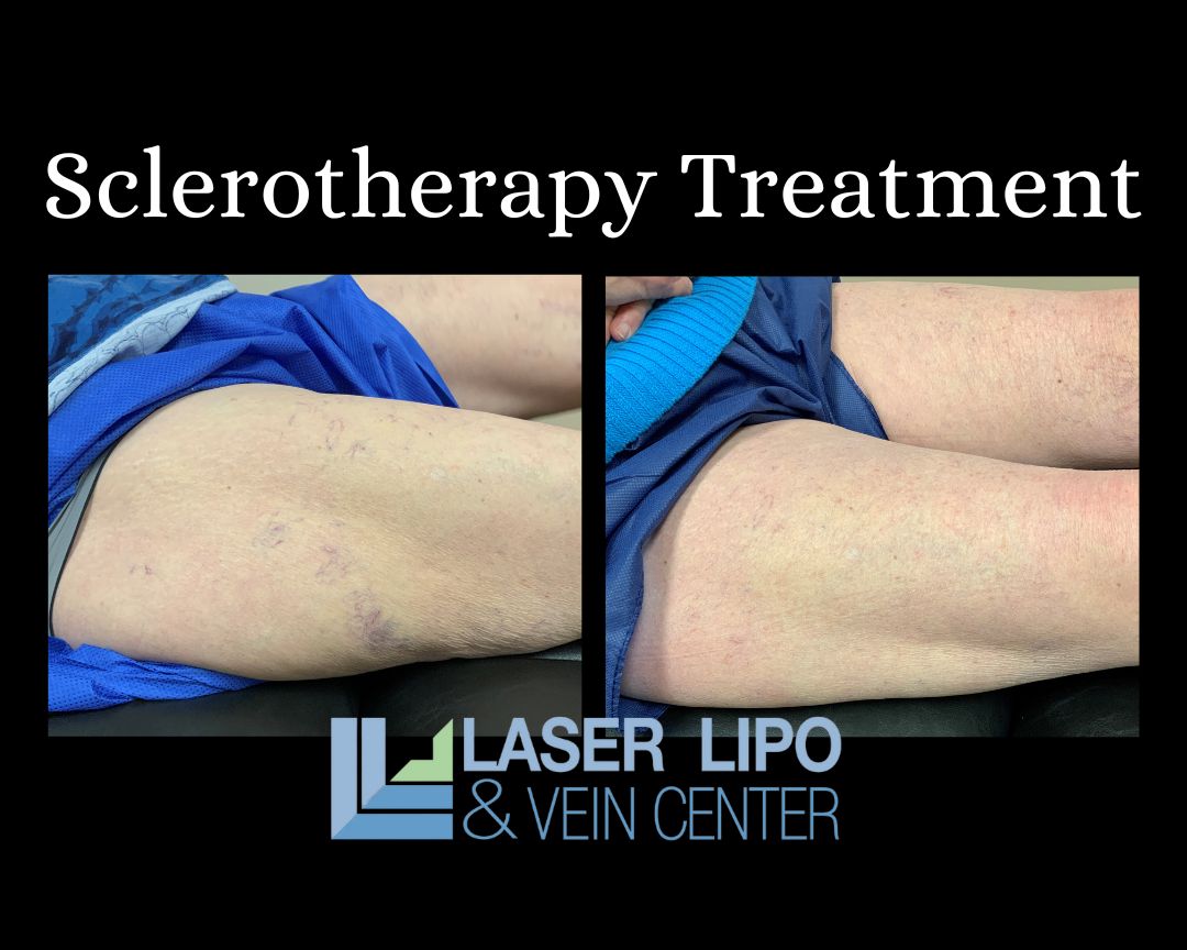 What to Expect After Sclerotherapy Treatment | St Louis Laser Veins